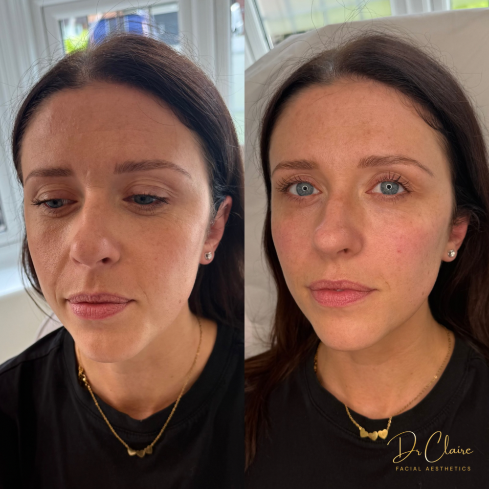 Transformations | Dr Claire Facial Aesthetics | Botox Chorley | Fillers Chorley | Aesthetics Chorley | Botox Treatments Chorley | Dermal Fillers Chorley | Aesthetic Enhancements Chorley