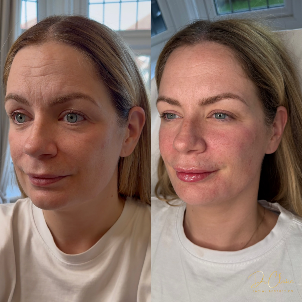 Transformations | Dr Claire Facial Aesthetics | Botox Chorley | Fillers Chorley | Aesthetics Chorley | Botox Treatments Chorley | Dermal Fillers Chorley | Aesthetic Enhancements Chorley