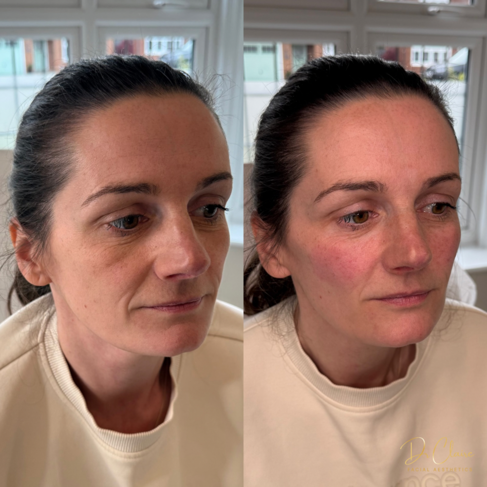 Transformations | Dr Claire Facial Aesthetics | Botox Chorley | Fillers Chorley | Aesthetics Chorley | Botox Treatments Chorley | Dermal Fillers Chorley | Aesthetic Enhancements Chorley