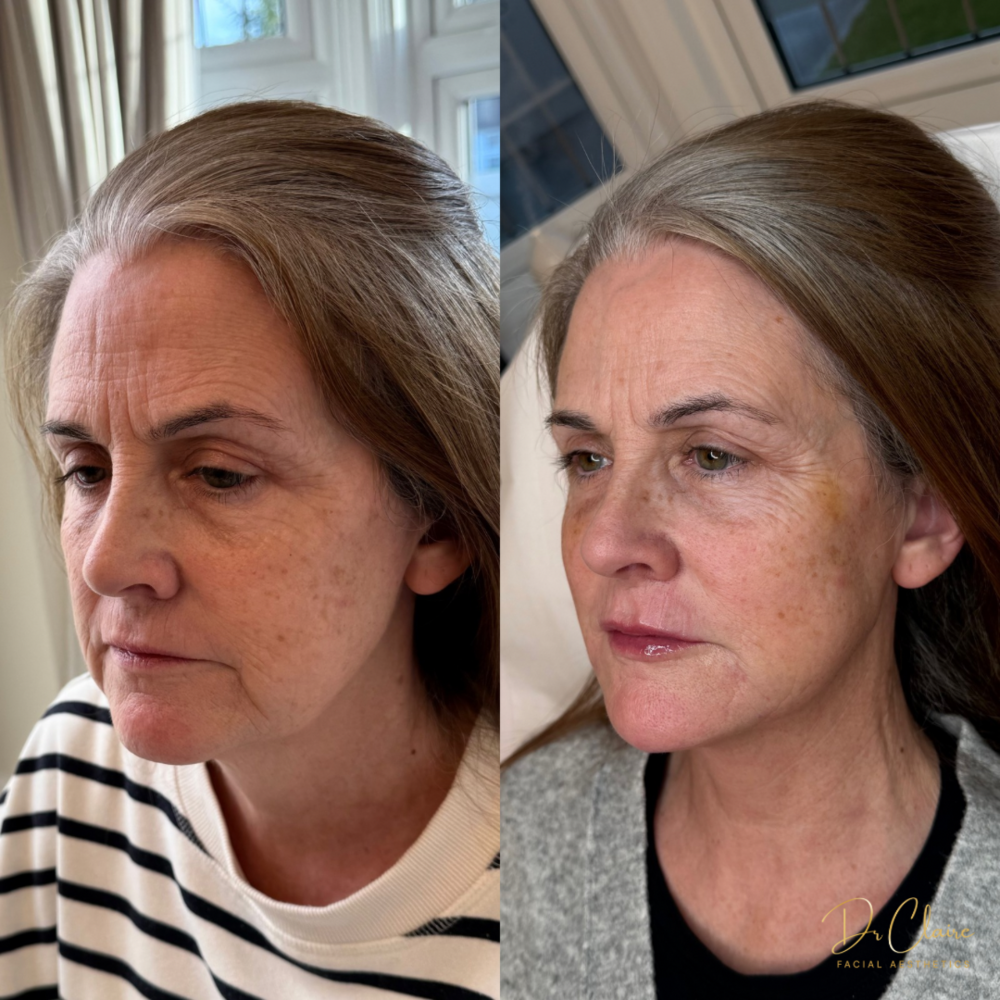 Transformations | Dr Claire Facial Aesthetics | Botox Chorley | Fillers Chorley | Aesthetics Chorley | Botox Treatments Chorley | Dermal Fillers Chorley | Aesthetic Enhancements Chorley
