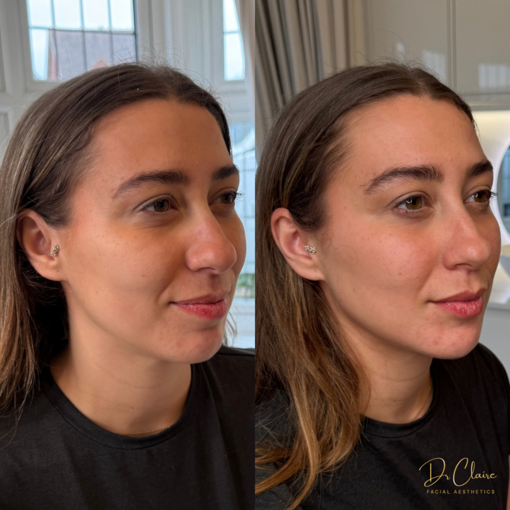 Transformations | Dr Claire Facial Aesthetics | Botox Chorley | Fillers Chorley | Aesthetics Chorley | Botox Treatments Chorley | Dermal Fillers Chorley | Aesthetic Enhancements Chorley