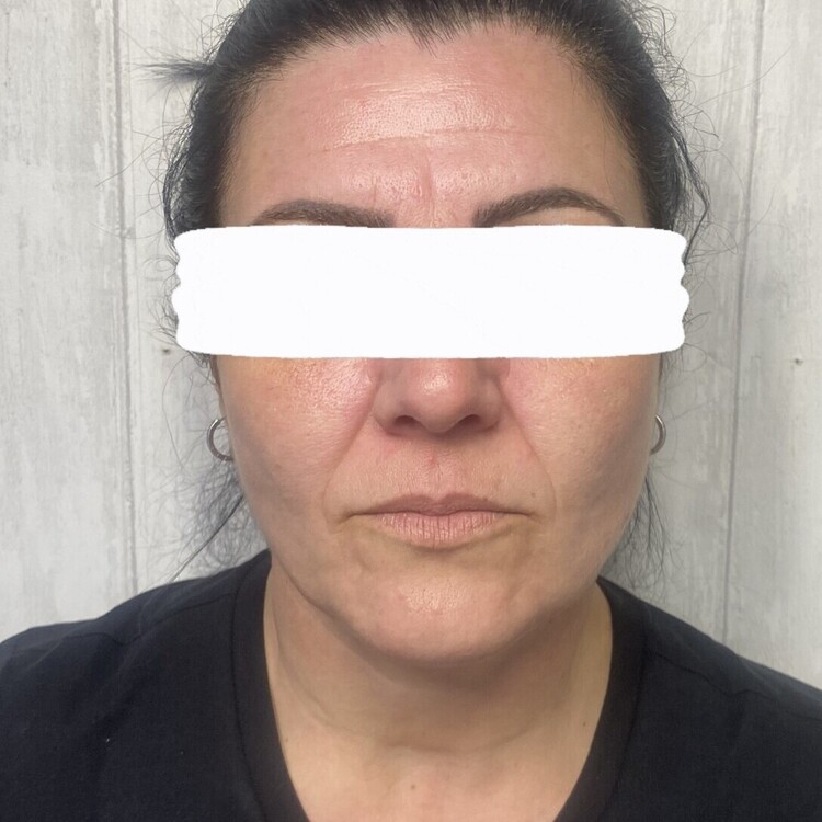 Before & After Results