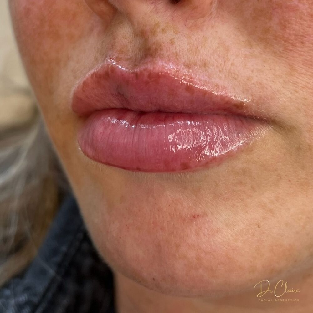 Transformations | Dr Claire Facial Aesthetics | Botox Chorley | Fillers Chorley | Aesthetics Chorley | Botox Treatments Chorley | Dermal Fillers Chorley | Aesthetic Enhancements Chorley