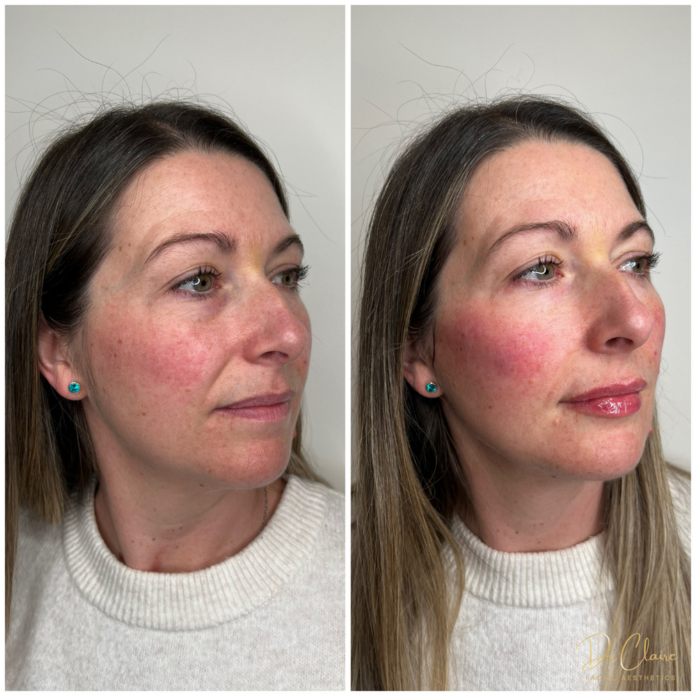 Transformations | Dr Claire Facial Aesthetics | Botox Chorley | Fillers Chorley | Aesthetics Chorley | Botox Treatments Chorley | Dermal Fillers Chorley | Aesthetic Enhancements Chorley