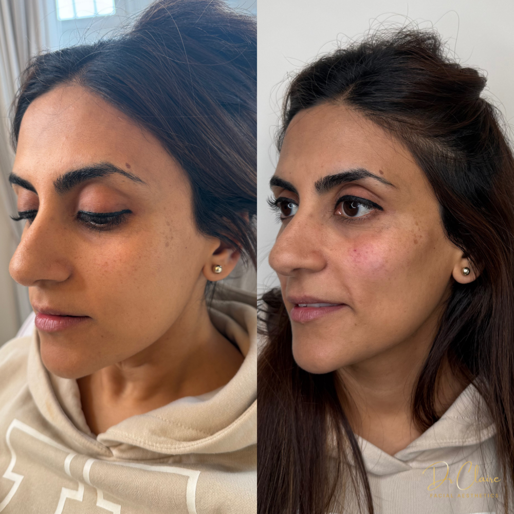 Transformations | Dr Claire Facial Aesthetics | Botox Chorley | Fillers Chorley | Aesthetics Chorley | Botox Treatments Chorley | Dermal Fillers Chorley | Aesthetic Enhancements Chorley