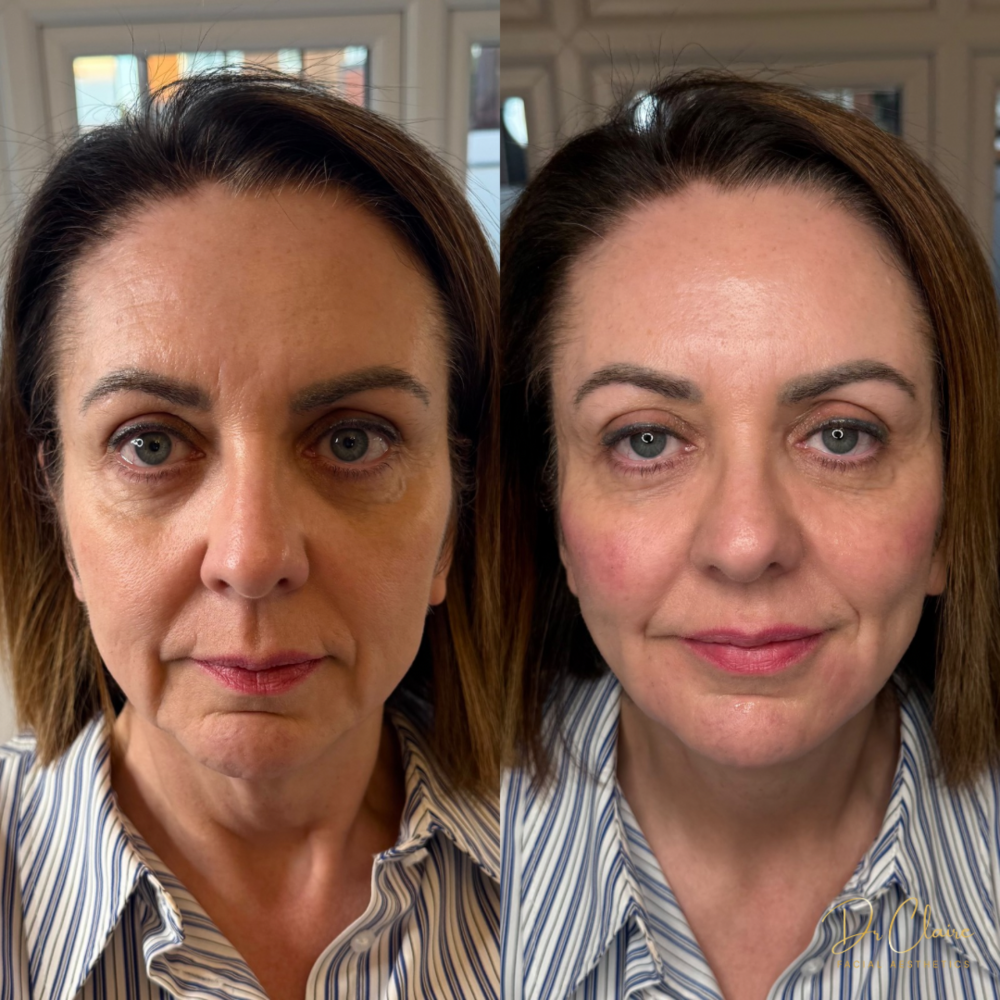 Transformations | Dr Claire Facial Aesthetics | Botox Chorley | Fillers Chorley | Aesthetics Chorley | Botox Treatments Chorley | Dermal Fillers Chorley | Aesthetic Enhancements Chorley