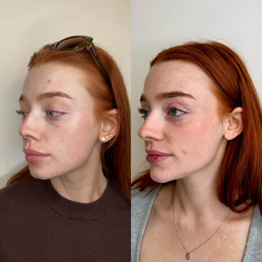 Transformations | Dr Claire Facial Aesthetics | Botox Chorley | Fillers Chorley | Aesthetics Chorley | Botox Treatments Chorley | Dermal Fillers Chorley | Aesthetic Enhancements Chorley