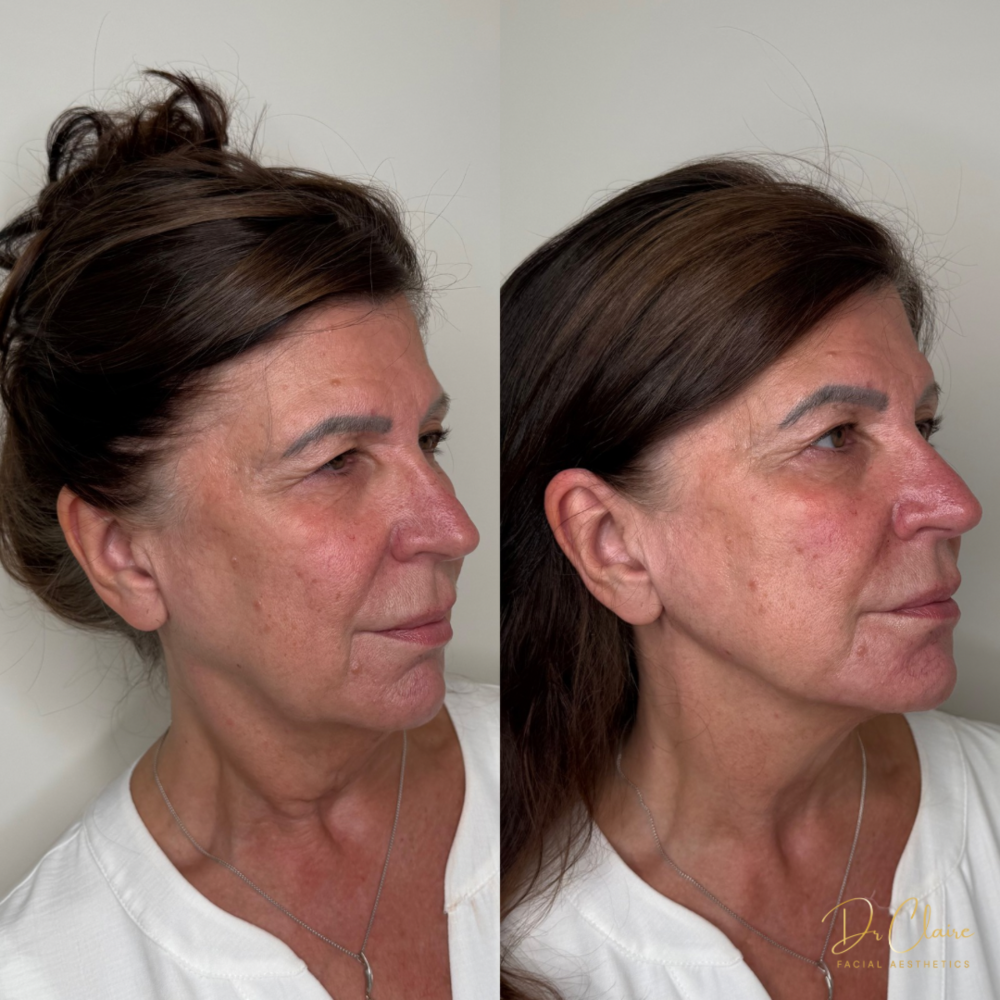 Transformations | Dr Claire Facial Aesthetics | Botox Chorley | Fillers Chorley | Aesthetics Chorley | Botox Treatments Chorley | Dermal Fillers Chorley | Aesthetic Enhancements Chorley