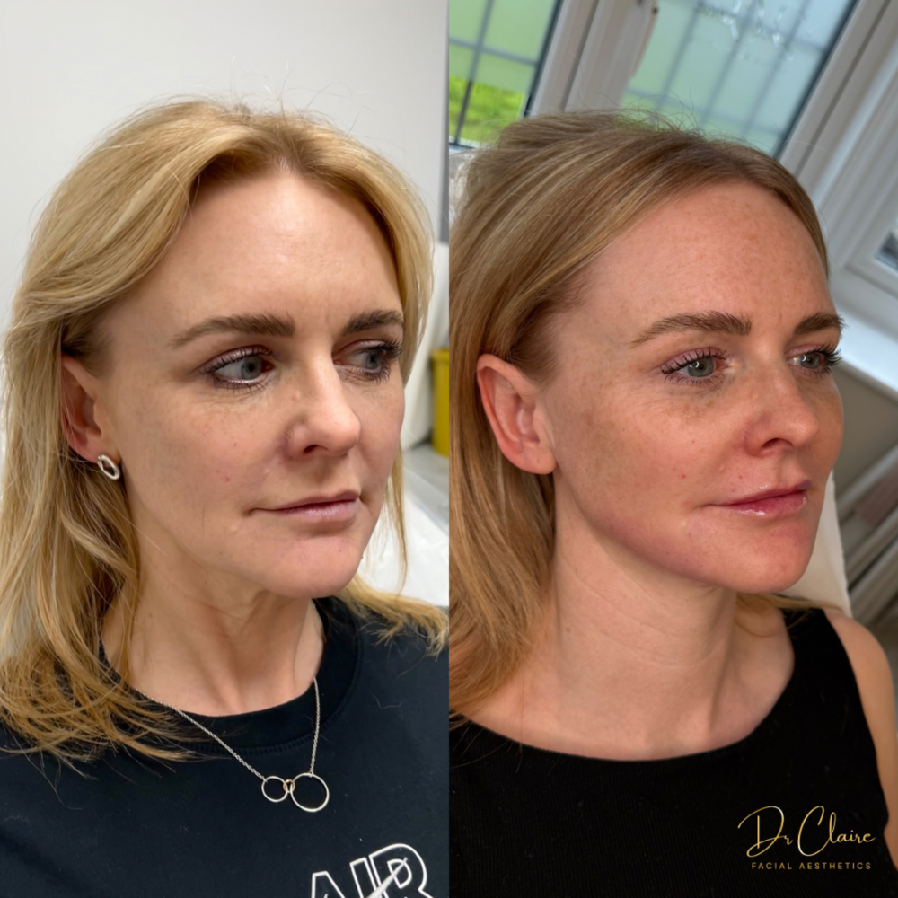 Transformations | Dr Claire Facial Aesthetics | Botox Chorley | Fillers Chorley | Aesthetics Chorley | Botox Treatments Chorley | Dermal Fillers Chorley | Aesthetic Enhancements Chorley
