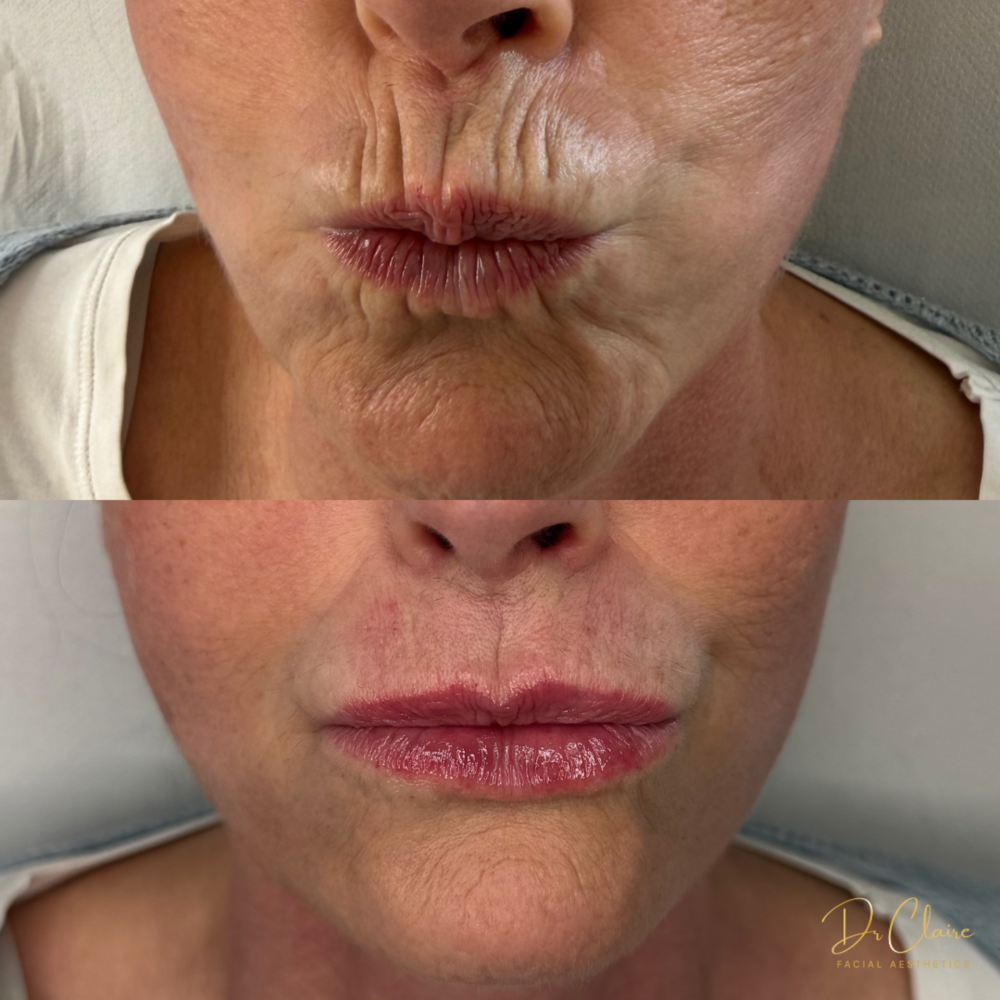 Transformations | Dr Claire Facial Aesthetics | Botox Chorley | Fillers Chorley | Aesthetics Chorley | Botox Treatments Chorley | Dermal Fillers Chorley | Aesthetic Enhancements Chorley