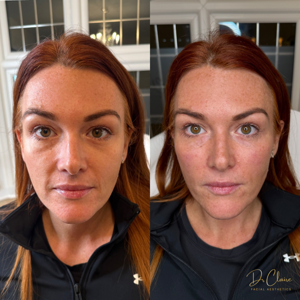 Transformations | Dr Claire Facial Aesthetics | Botox Chorley | Fillers Chorley | Aesthetics Chorley | Botox Treatments Chorley | Dermal Fillers Chorley | Aesthetic Enhancements Chorley