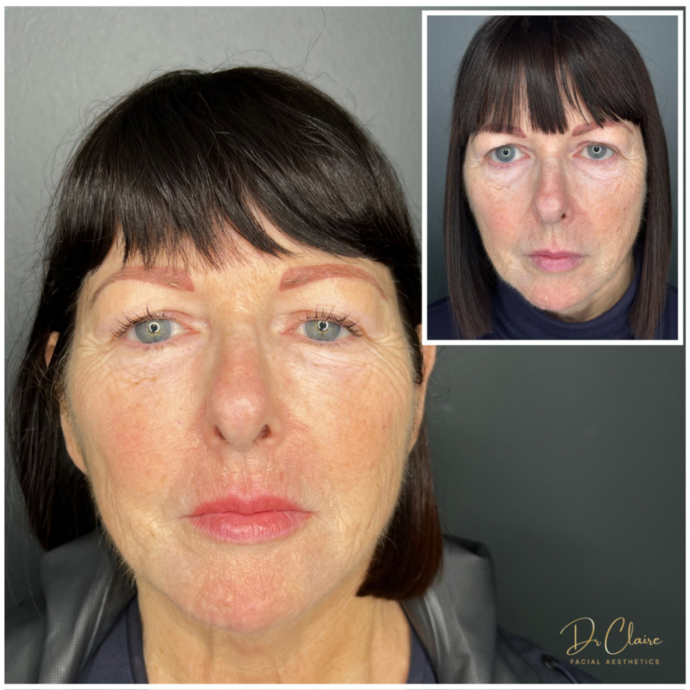 Transformations | Dr Claire Facial Aesthetics | Botox Chorley | Fillers Chorley | Aesthetics Chorley | Botox Treatments Chorley | Dermal Fillers Chorley | Aesthetic Enhancements Chorley