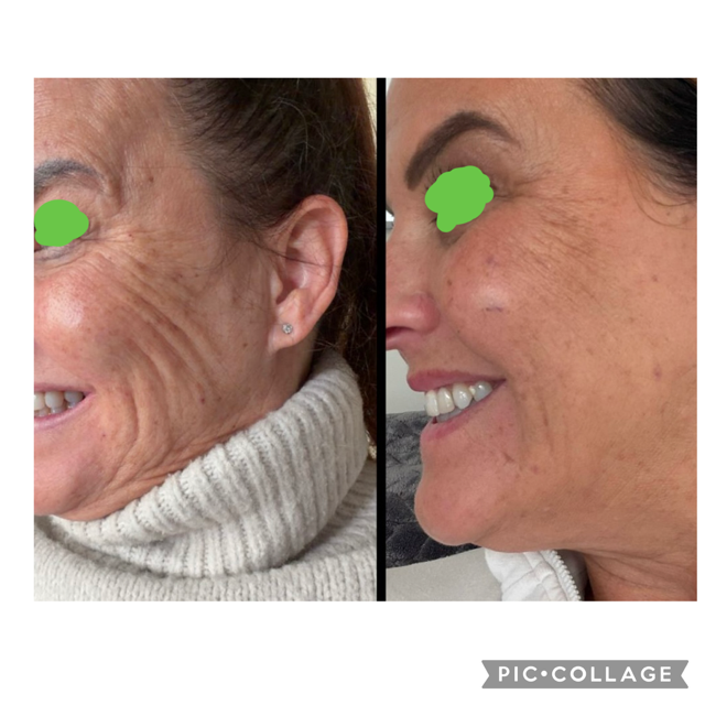 Before &amp; After | Clk medical aesthetics