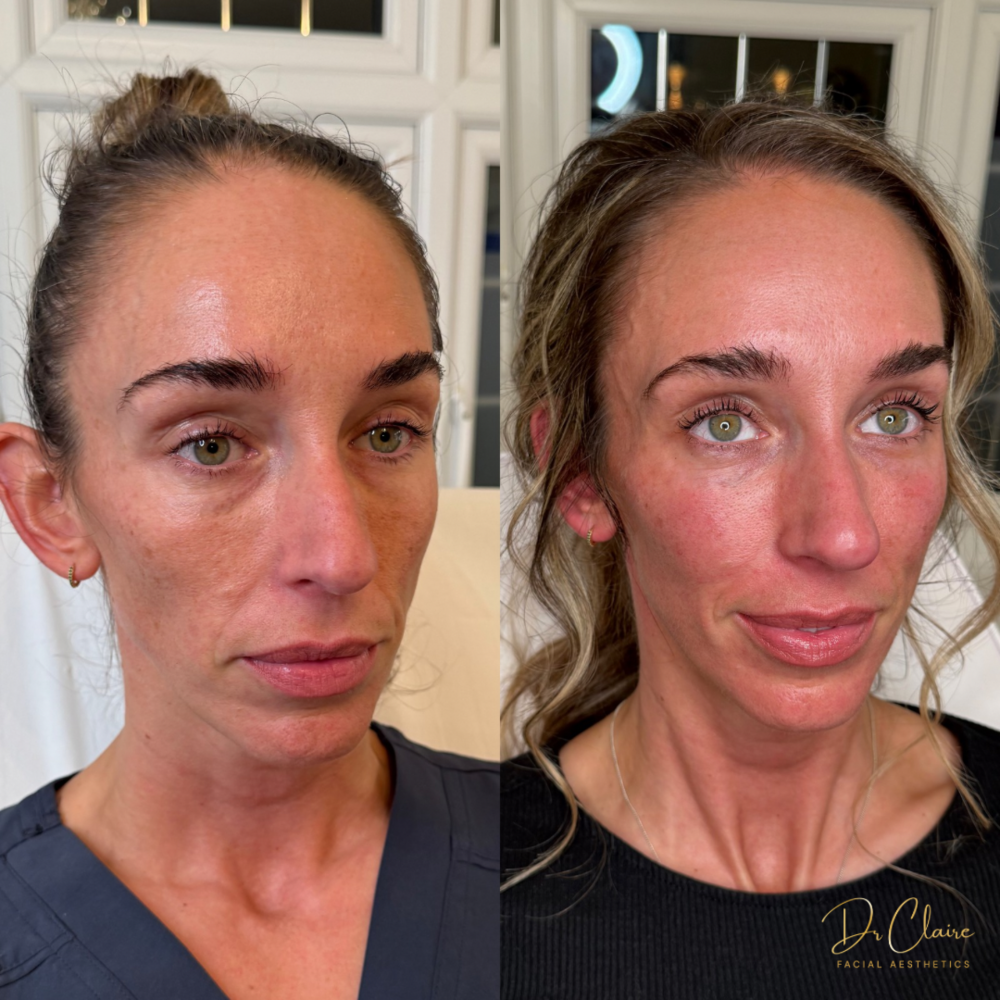 Transformations | Dr Claire Facial Aesthetics | Botox Chorley | Fillers Chorley | Aesthetics Chorley | Botox Treatments Chorley | Dermal Fillers Chorley | Aesthetic Enhancements Chorley