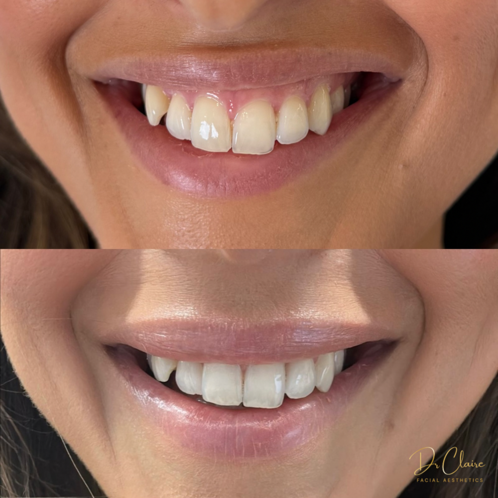 Transformations | Dr Claire Facial Aesthetics | Botox Chorley | Fillers Chorley | Aesthetics Chorley | Botox Treatments Chorley | Dermal Fillers Chorley | Aesthetic Enhancements Chorley