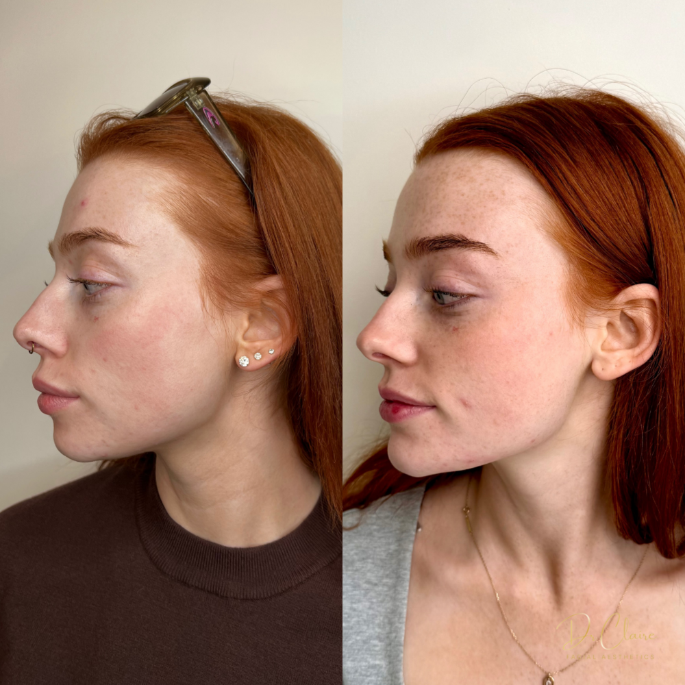 Transformations | Dr Claire Facial Aesthetics | Botox Chorley | Fillers Chorley | Aesthetics Chorley | Botox Treatments Chorley | Dermal Fillers Chorley | Aesthetic Enhancements Chorley