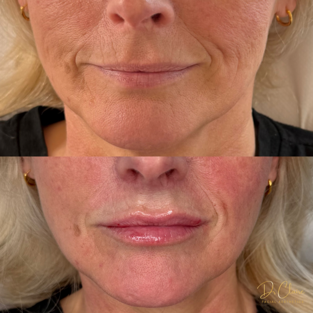 Transformations | Dr Claire Facial Aesthetics | Botox Chorley | Fillers Chorley | Aesthetics Chorley | Botox Treatments Chorley | Dermal Fillers Chorley | Aesthetic Enhancements Chorley