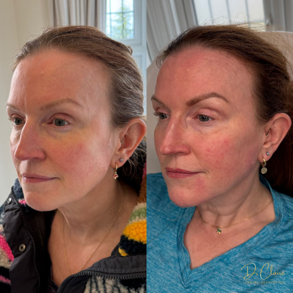 Transformations | Dr Claire Facial Aesthetics | Botox Chorley | Fillers Chorley | Aesthetics Chorley | Botox Treatments Chorley | Dermal Fillers Chorley | Aesthetic Enhancements Chorley