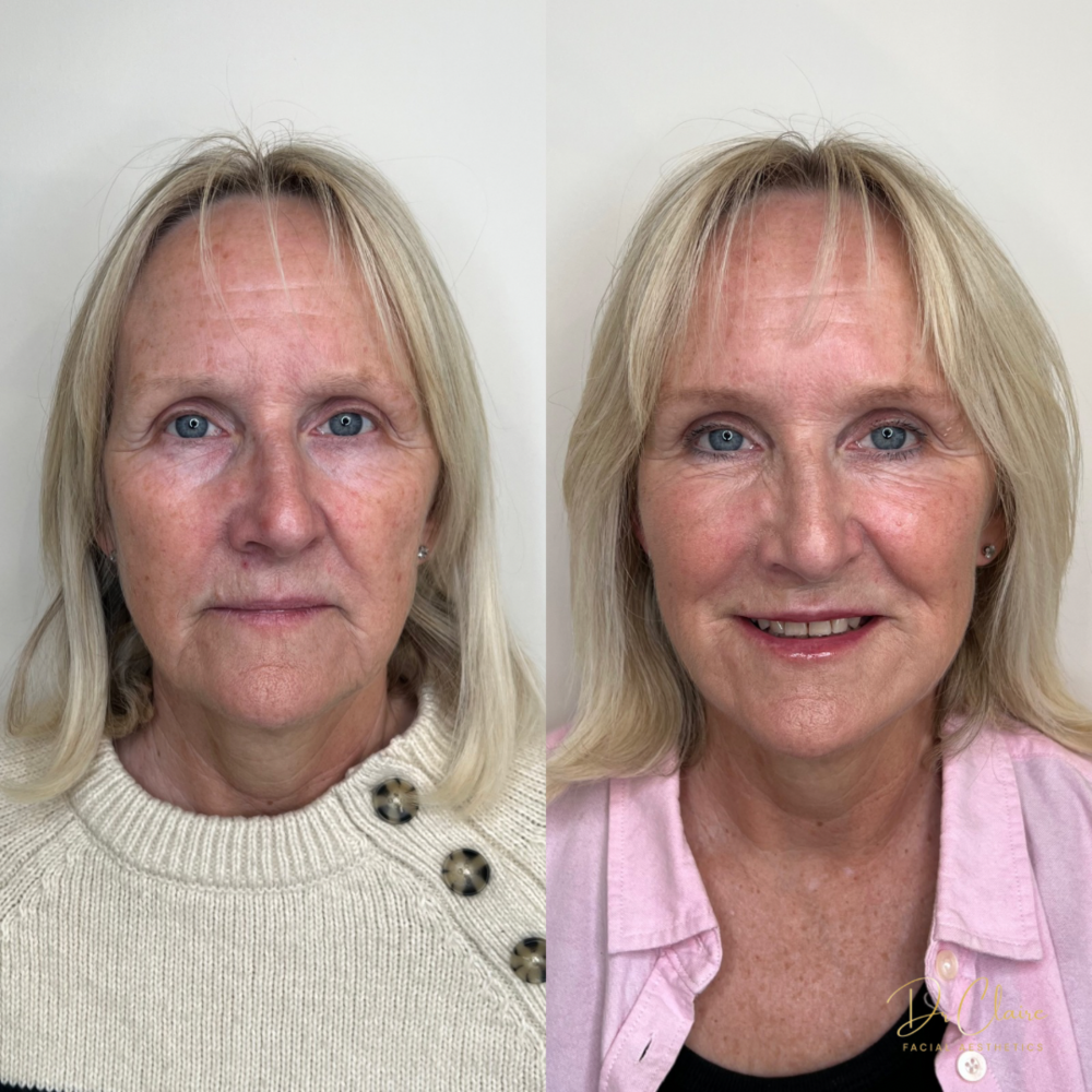 Transformations | Dr Claire Facial Aesthetics | Botox Chorley | Fillers Chorley | Aesthetics Chorley | Botox Treatments Chorley | Dermal Fillers Chorley | Aesthetic Enhancements Chorley