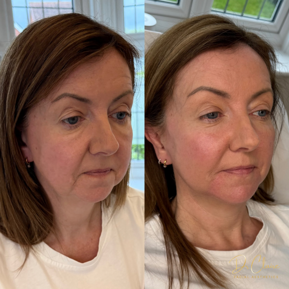 Transformations | Dr Claire Facial Aesthetics | Botox Chorley | Fillers Chorley | Aesthetics Chorley | Botox Treatments Chorley | Dermal Fillers Chorley | Aesthetic Enhancements Chorley