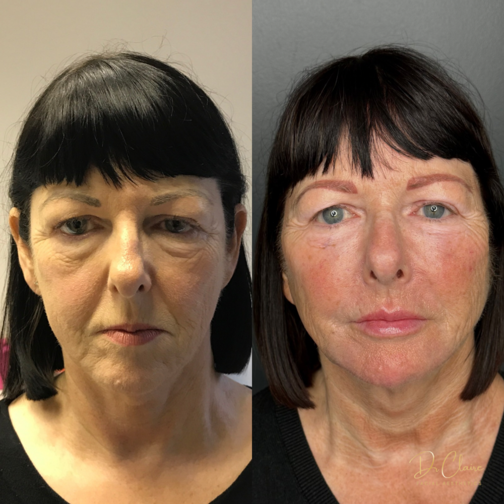 Transformations | Dr Claire Facial Aesthetics | Botox Chorley | Fillers Chorley | Aesthetics Chorley | Botox Treatments Chorley | Dermal Fillers Chorley | Aesthetic Enhancements Chorley