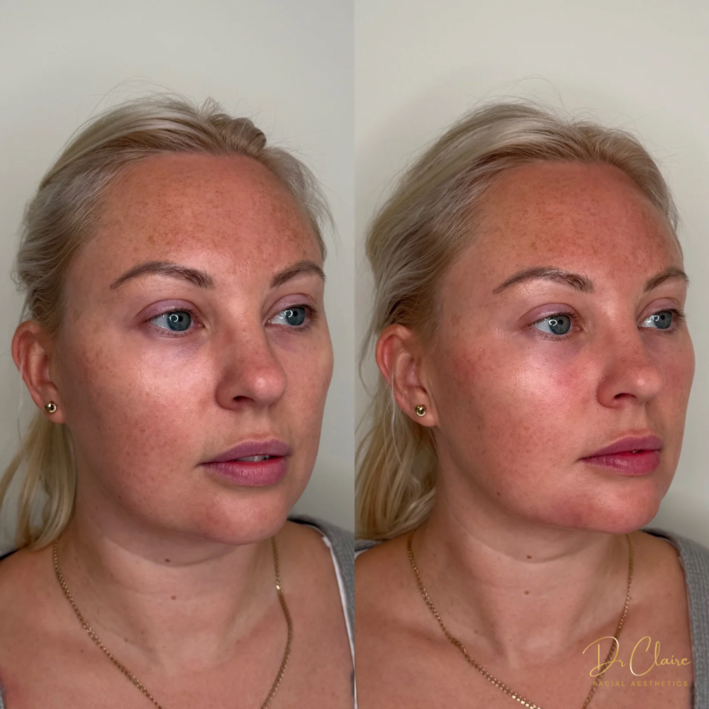 Transformations | Dr Claire Facial Aesthetics | Botox Chorley | Fillers Chorley | Aesthetics Chorley | Botox Treatments Chorley | Dermal Fillers Chorley | Aesthetic Enhancements Chorley
