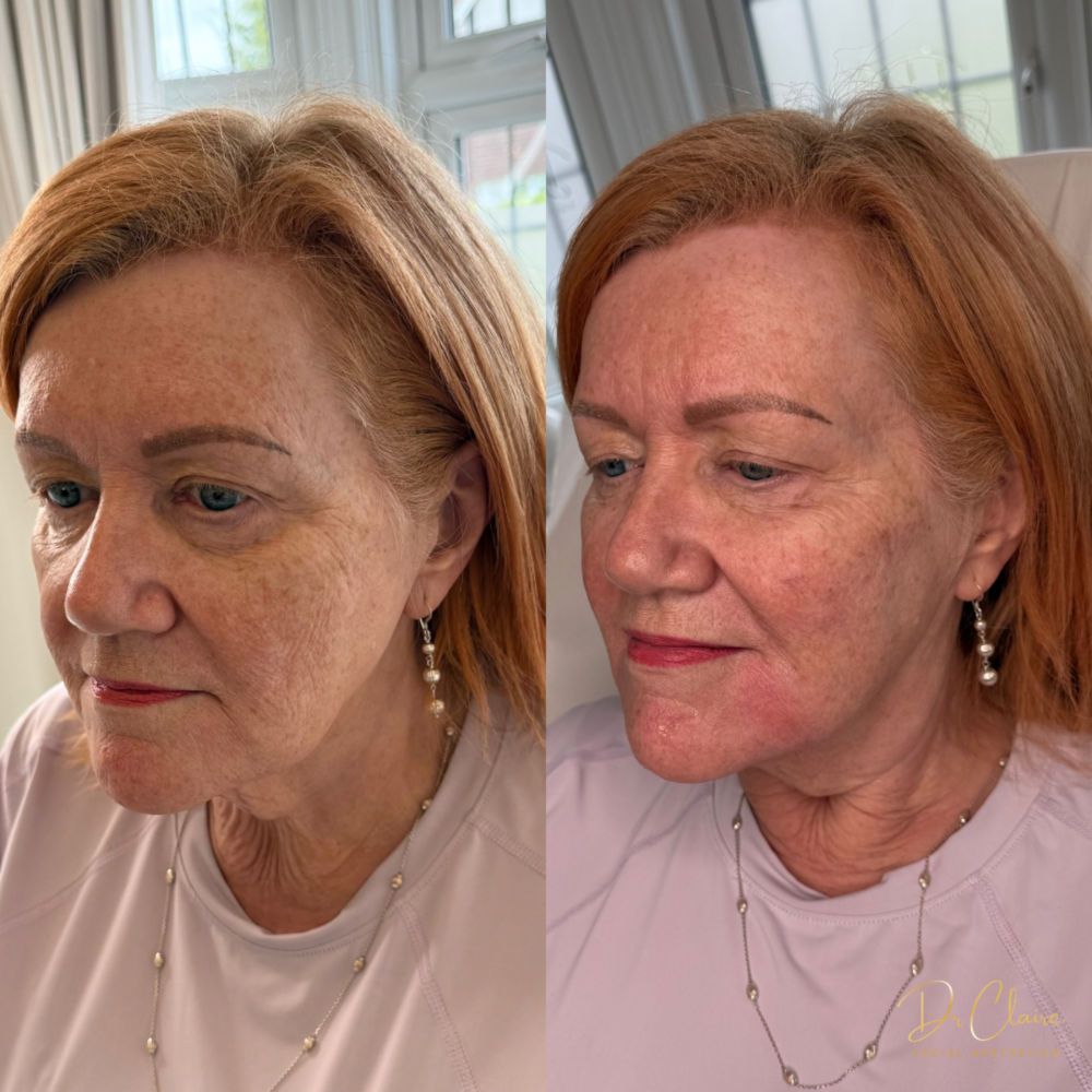 Transformations | Dr Claire Facial Aesthetics | Botox Chorley | Fillers Chorley | Aesthetics Chorley | Botox Treatments Chorley | Dermal Fillers Chorley | Aesthetic Enhancements Chorley