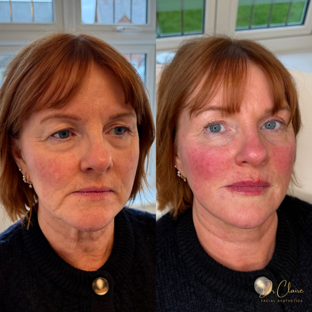 Transformations | Dr Claire Facial Aesthetics | Botox Chorley | Fillers Chorley | Aesthetics Chorley | Botox Treatments Chorley | Dermal Fillers Chorley | Aesthetic Enhancements Chorley