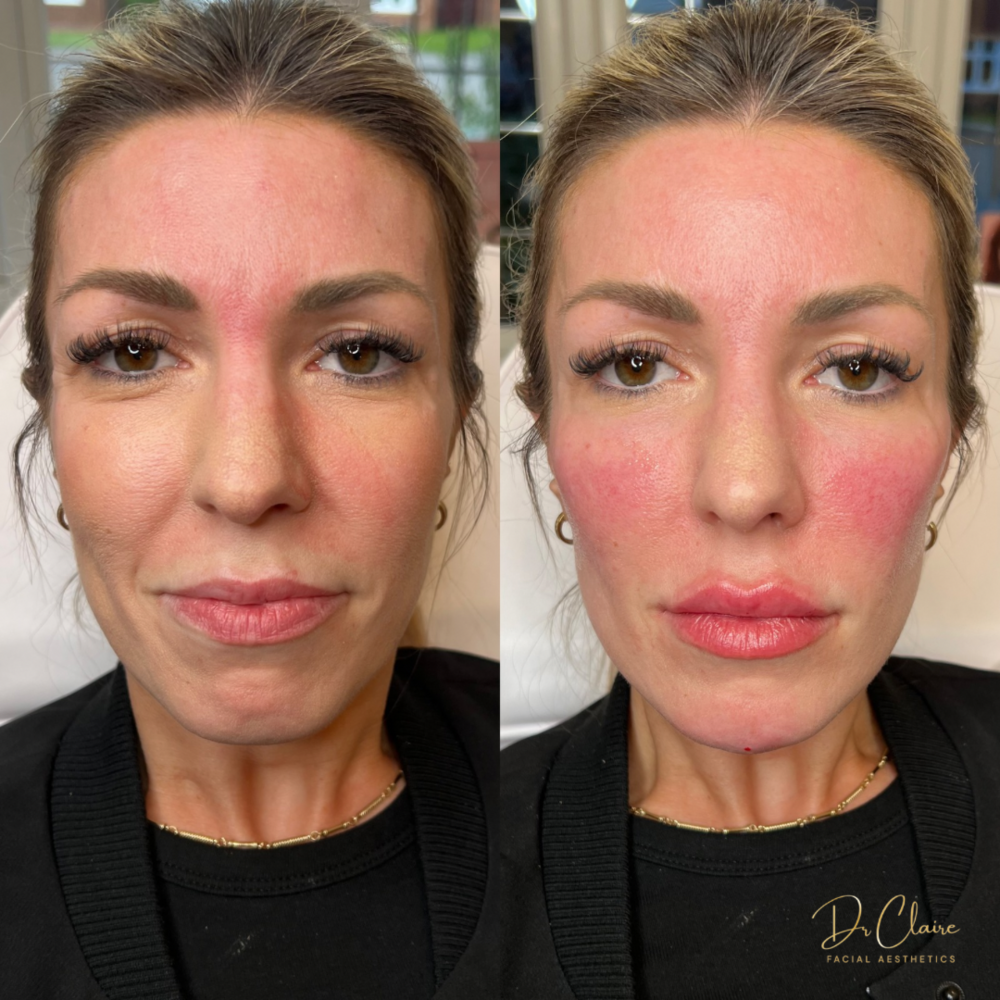 Transformations | Dr Claire Facial Aesthetics | Botox Chorley | Fillers Chorley | Aesthetics Chorley | Botox Treatments Chorley | Dermal Fillers Chorley | Aesthetic Enhancements Chorley