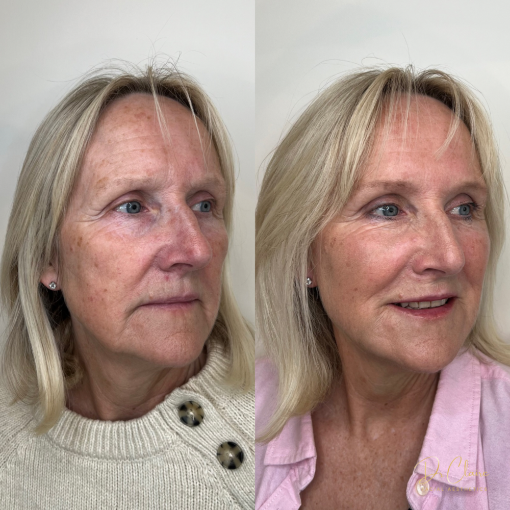 Transformations | Dr Claire Facial Aesthetics | Botox Chorley | Fillers Chorley | Aesthetics Chorley | Botox Treatments Chorley | Dermal Fillers Chorley | Aesthetic Enhancements Chorley