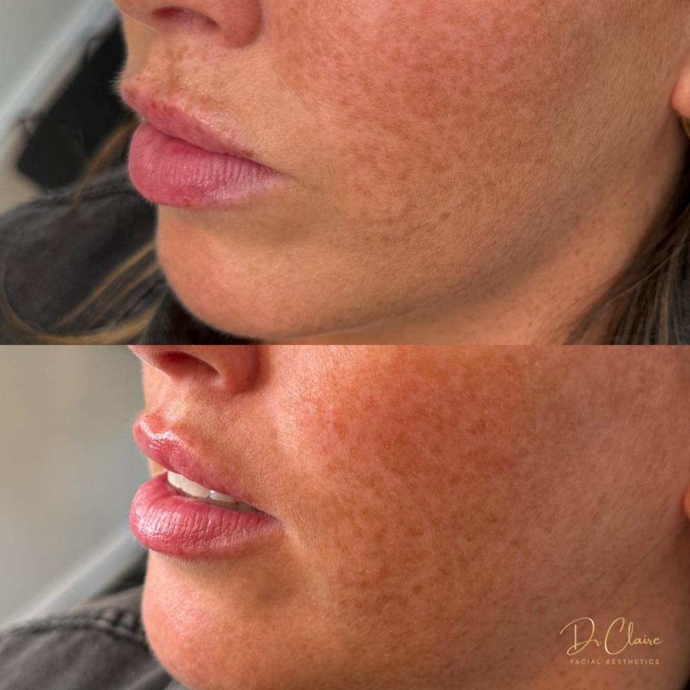 Transformations | Dr Claire Facial Aesthetics | Botox Chorley | Fillers Chorley | Aesthetics Chorley | Botox Treatments Chorley | Dermal Fillers Chorley | Aesthetic Enhancements Chorley