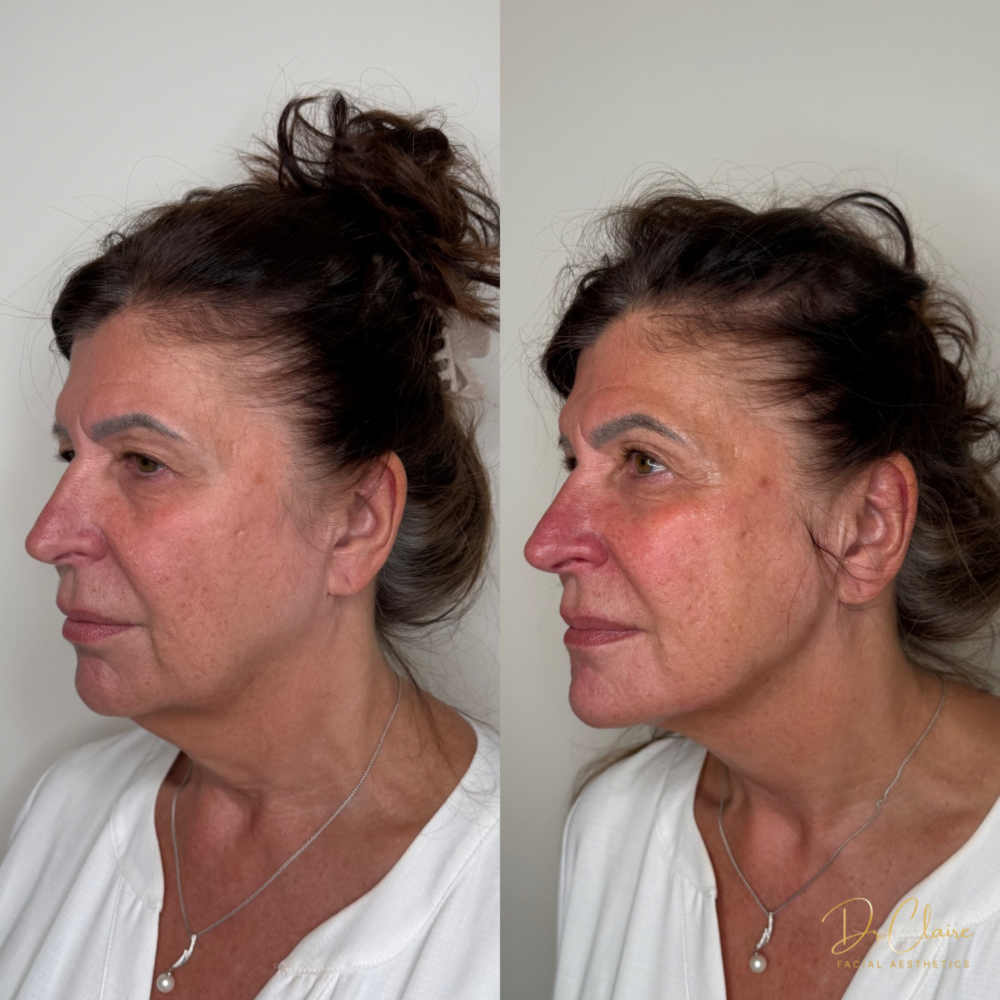 Transformations | Dr Claire Facial Aesthetics | Botox Chorley | Fillers Chorley | Aesthetics Chorley | Botox Treatments Chorley | Dermal Fillers Chorley | Aesthetic Enhancements Chorley