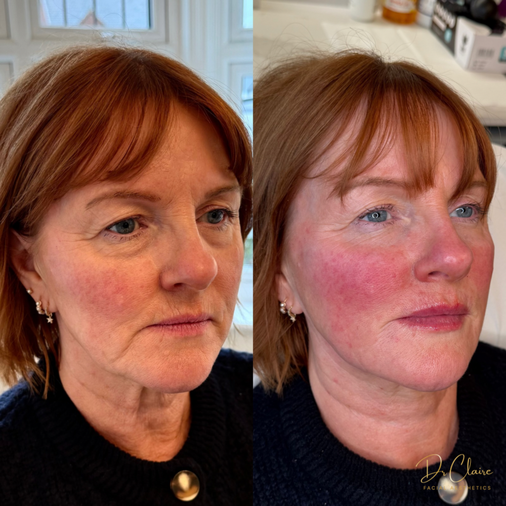 Transformations | Dr Claire Facial Aesthetics | Botox Chorley | Fillers Chorley | Aesthetics Chorley | Botox Treatments Chorley | Dermal Fillers Chorley | Aesthetic Enhancements Chorley