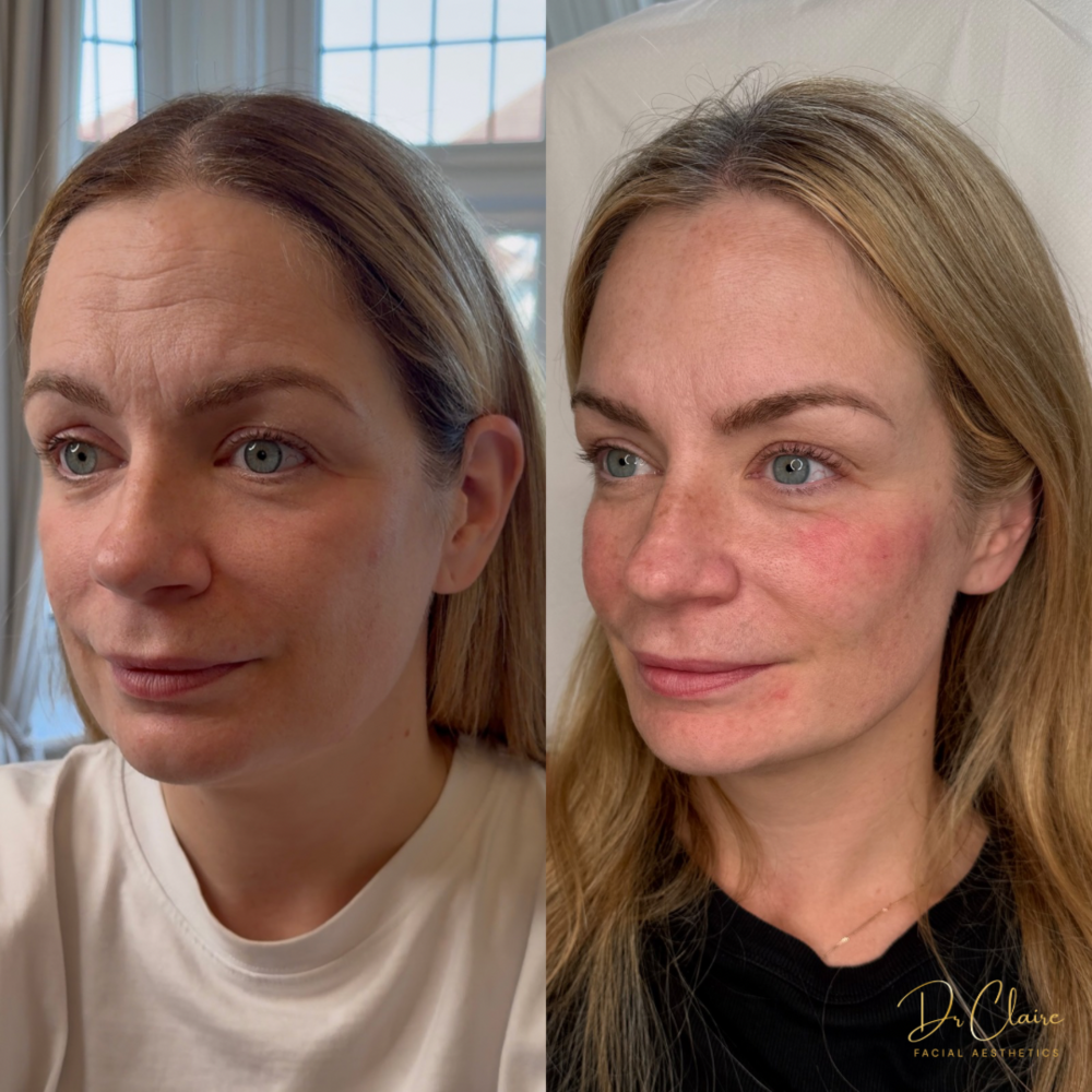 Transformations | Dr Claire Facial Aesthetics | Botox Chorley | Fillers Chorley | Aesthetics Chorley | Botox Treatments Chorley | Dermal Fillers Chorley | Aesthetic Enhancements Chorley