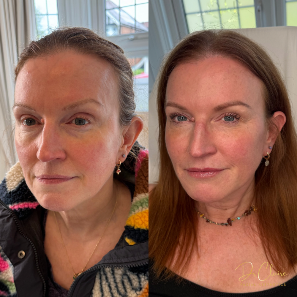 Transformations | Dr Claire Facial Aesthetics | Botox Chorley | Fillers Chorley | Aesthetics Chorley | Botox Treatments Chorley | Dermal Fillers Chorley | Aesthetic Enhancements Chorley