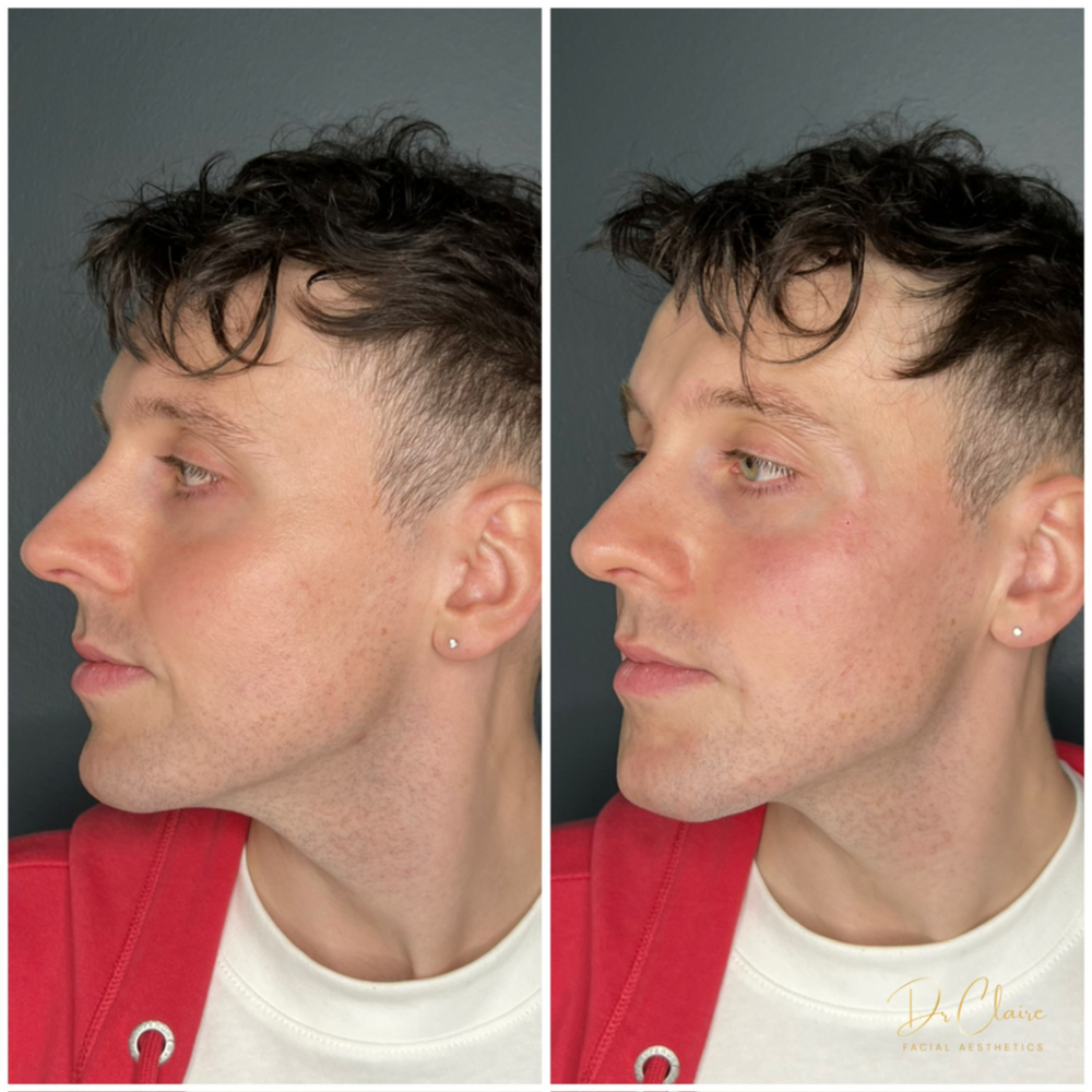 Transformations | Dr Claire Facial Aesthetics | Botox Chorley | Fillers Chorley | Aesthetics Chorley | Botox Treatments Chorley | Dermal Fillers Chorley | Aesthetic Enhancements Chorley