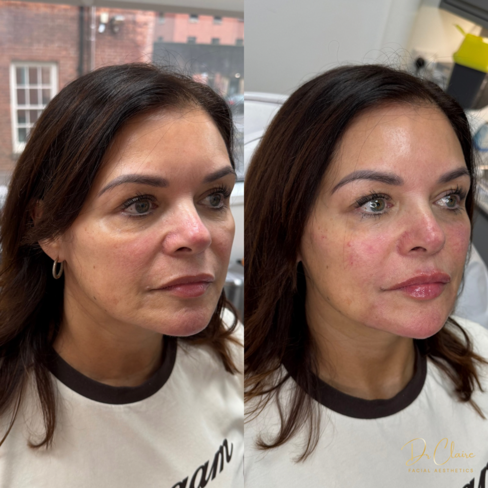 Transformations | Dr Claire Facial Aesthetics | Botox Chorley | Fillers Chorley | Aesthetics Chorley | Botox Treatments Chorley | Dermal Fillers Chorley | Aesthetic Enhancements Chorley