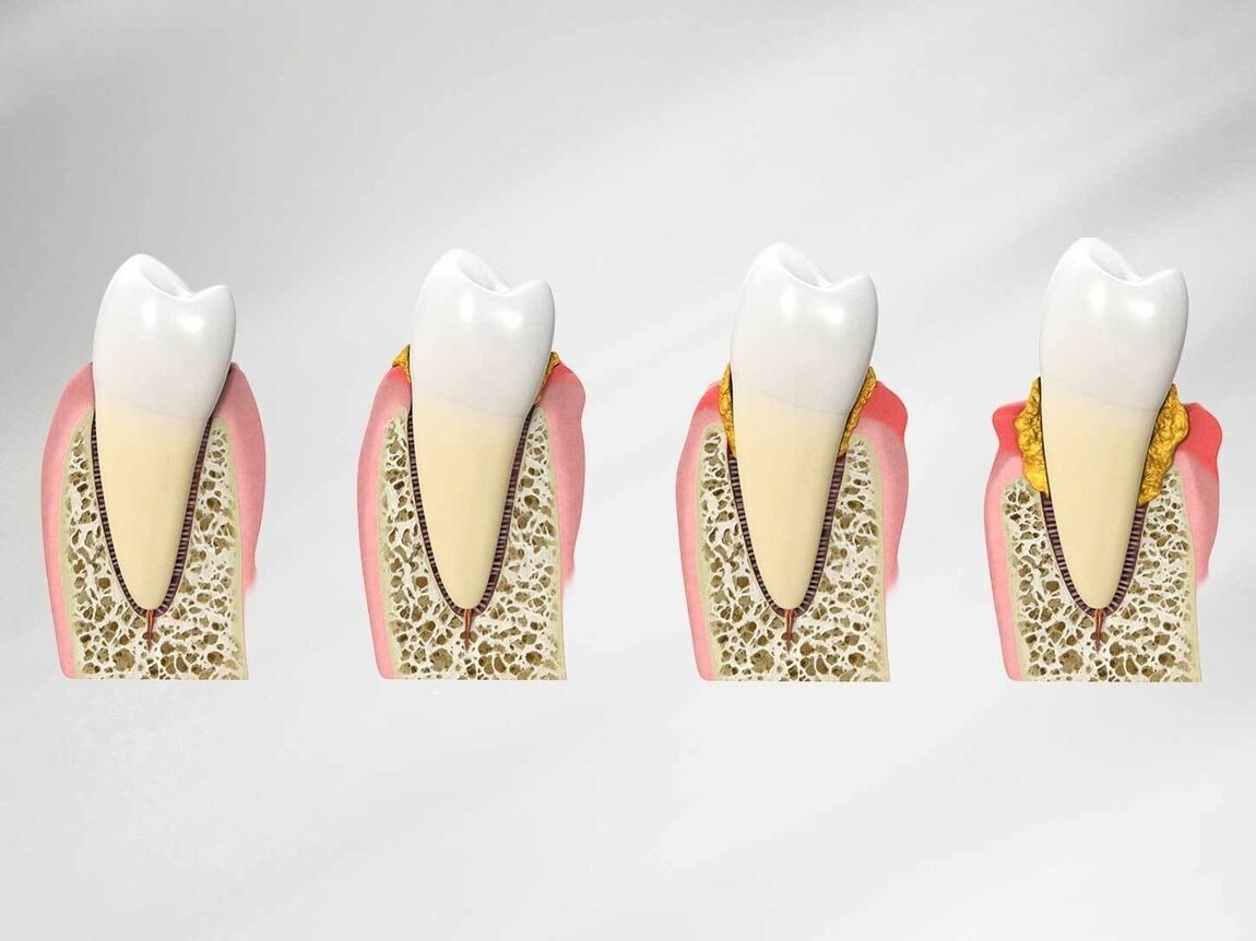 Advanced Gum Treatment | Cramond House Dental Practice | Dentist Clitheroe Preston Manchester | Dental Implants Clitheroe Preston Manchester | Gum Surgery Clitheroe Preston Manchester