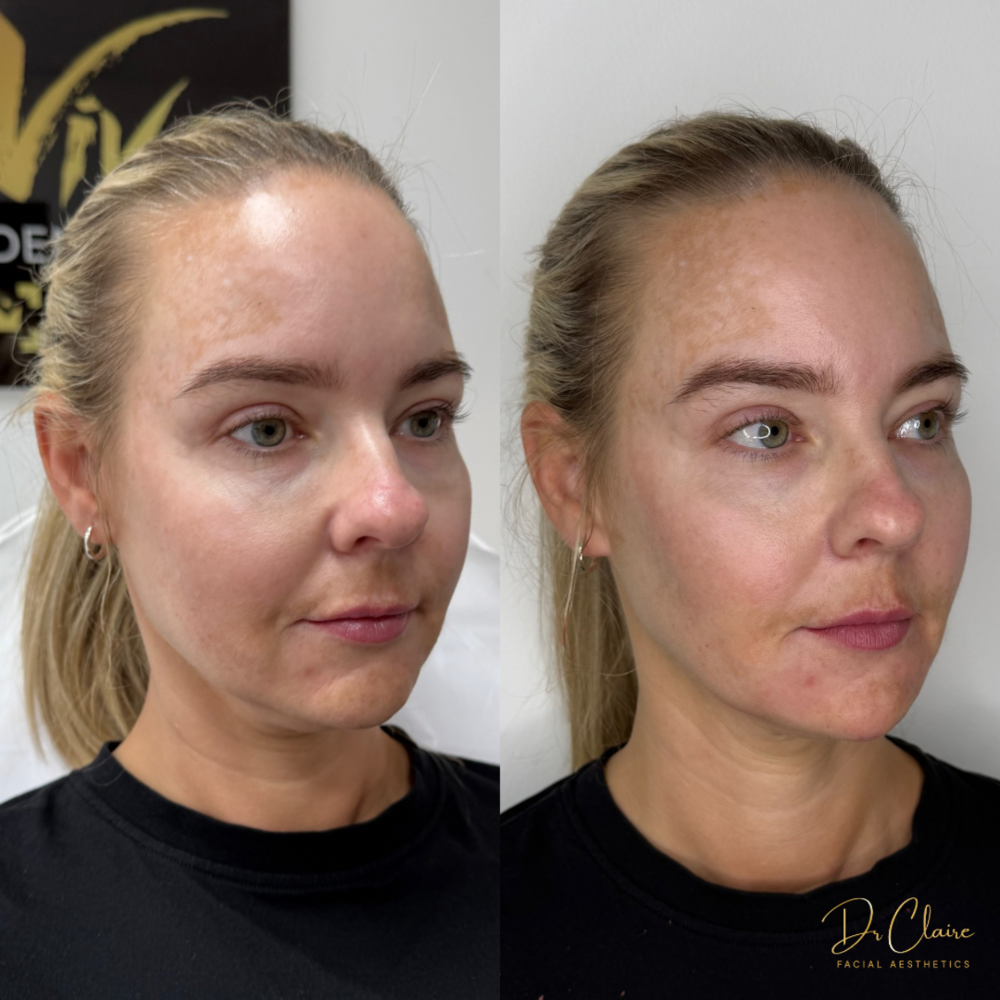Transformations | Dr Claire Facial Aesthetics | Botox Chorley | Fillers Chorley | Aesthetics Chorley | Botox Treatments Chorley | Dermal Fillers Chorley | Aesthetic Enhancements Chorley