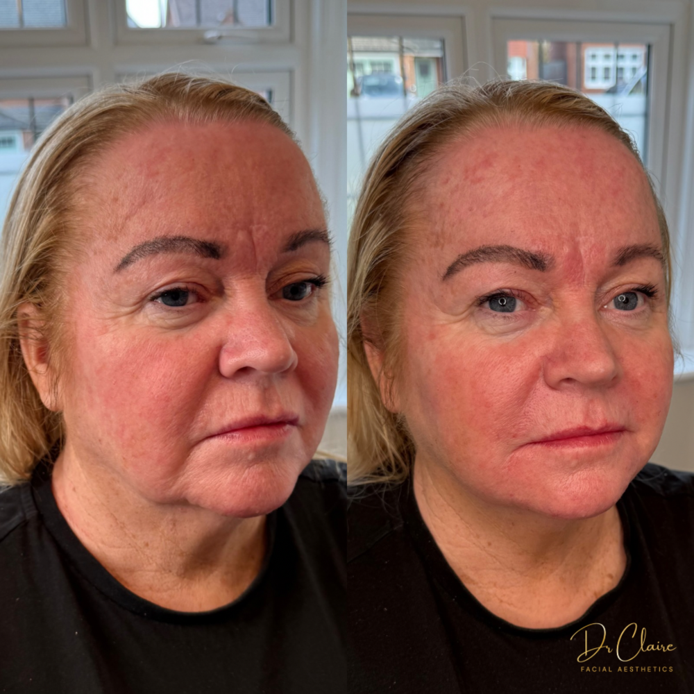 Transformations | Dr Claire Facial Aesthetics | Botox Chorley | Fillers Chorley | Aesthetics Chorley | Botox Treatments Chorley | Dermal Fillers Chorley | Aesthetic Enhancements Chorley