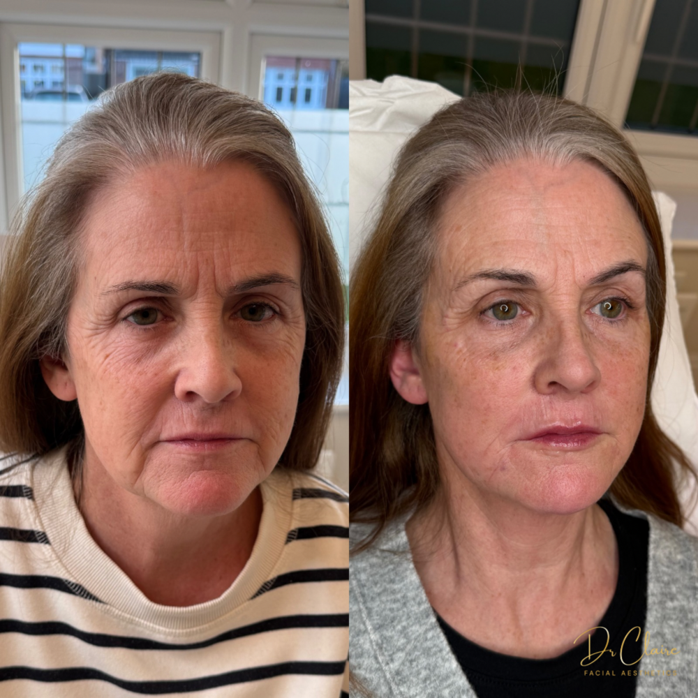 Transformations | Dr Claire Facial Aesthetics | Botox Chorley | Fillers Chorley | Aesthetics Chorley | Botox Treatments Chorley | Dermal Fillers Chorley | Aesthetic Enhancements Chorley