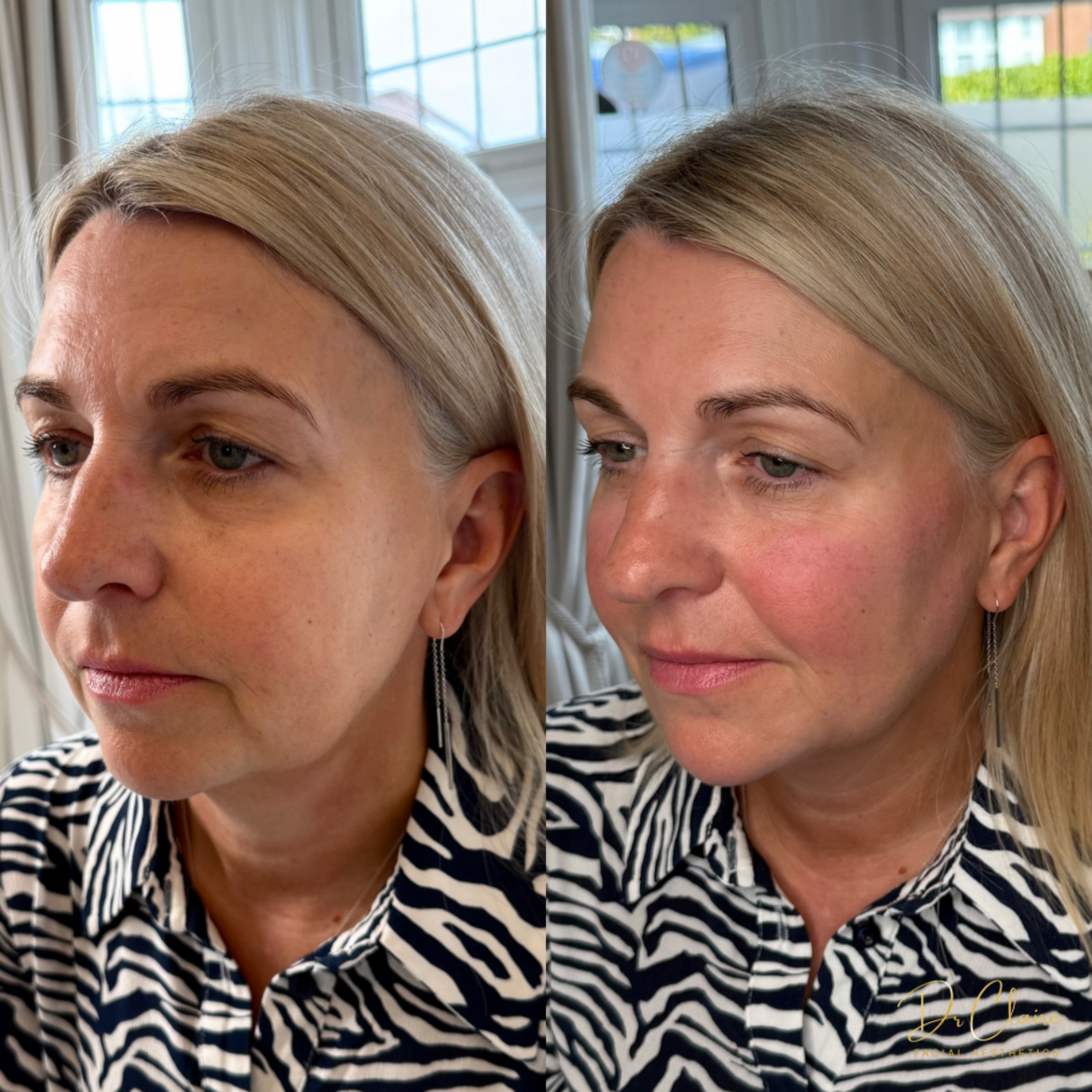 Transformations | Dr Claire Facial Aesthetics | Botox Chorley | Fillers Chorley | Aesthetics Chorley | Botox Treatments Chorley | Dermal Fillers Chorley | Aesthetic Enhancements Chorley