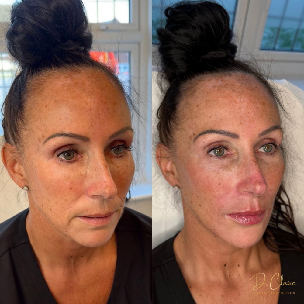 Transformations | Dr Claire Facial Aesthetics | Botox Chorley | Fillers Chorley | Aesthetics Chorley | Botox Treatments Chorley | Dermal Fillers Chorley | Aesthetic Enhancements Chorley