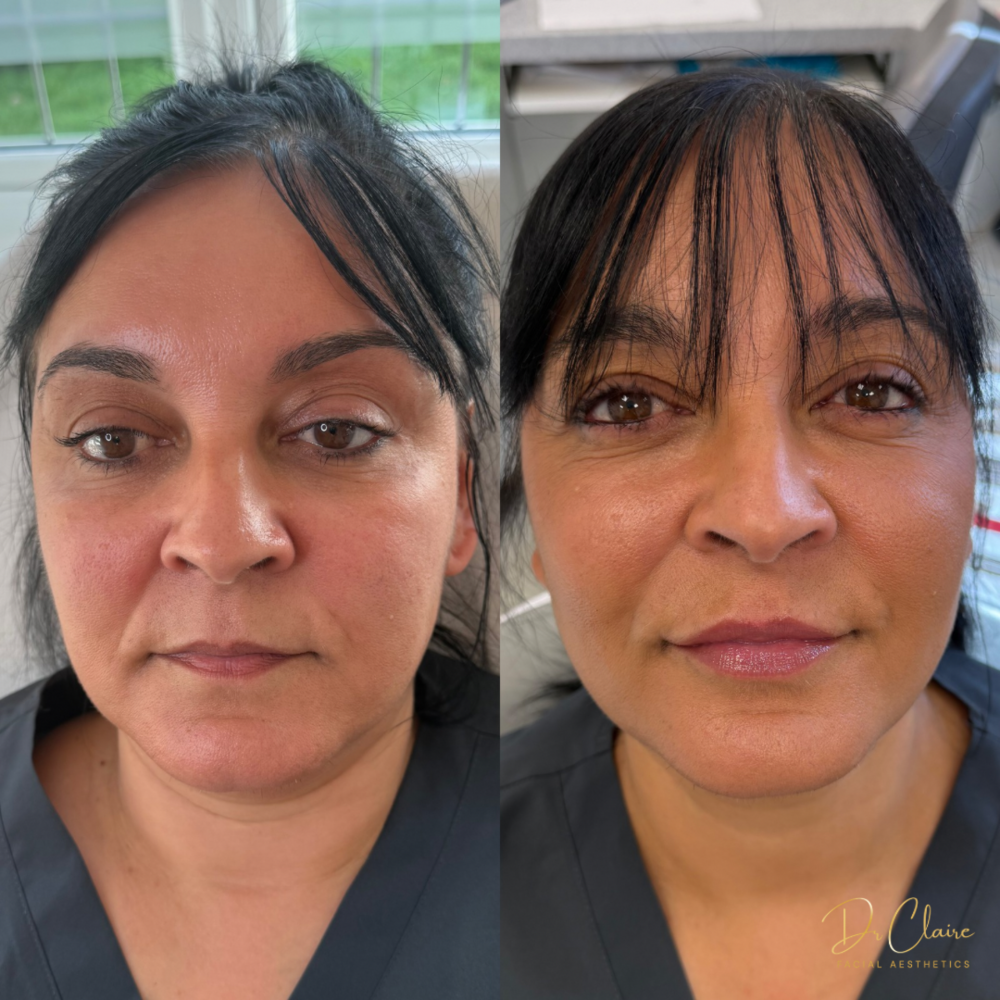 Transformations | Dr Claire Facial Aesthetics | Botox Chorley | Fillers Chorley | Aesthetics Chorley | Botox Treatments Chorley | Dermal Fillers Chorley | Aesthetic Enhancements Chorley