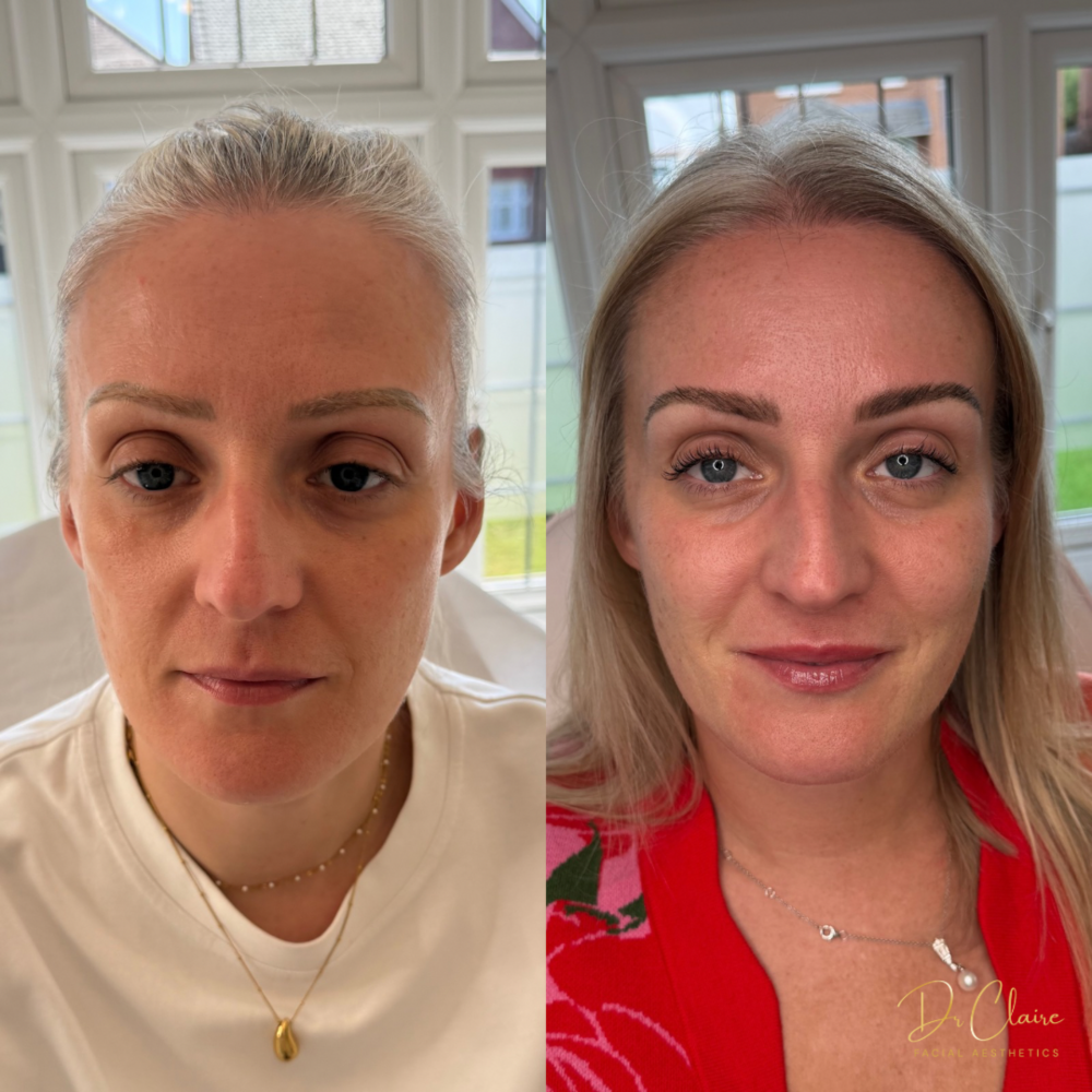 Transformations | Dr Claire Facial Aesthetics | Botox Chorley | Fillers Chorley | Aesthetics Chorley | Botox Treatments Chorley | Dermal Fillers Chorley | Aesthetic Enhancements Chorley