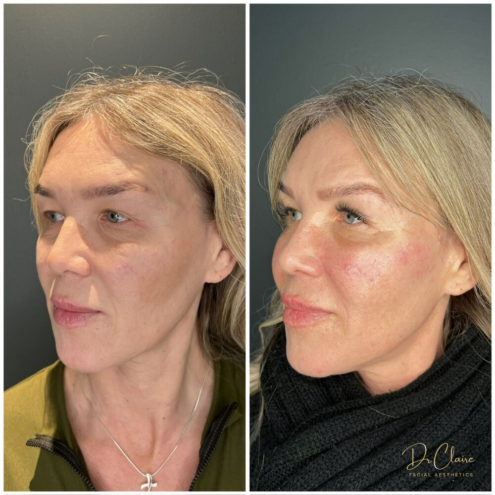 Transformations | Dr Claire Facial Aesthetics | Botox Chorley | Fillers Chorley | Aesthetics Chorley | Botox Treatments Chorley | Dermal Fillers Chorley | Aesthetic Enhancements Chorley