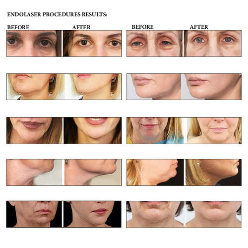 Endo lift /Endolaser results  | The Tx Room / medical wellness and skin clinic/endolift/endolaser