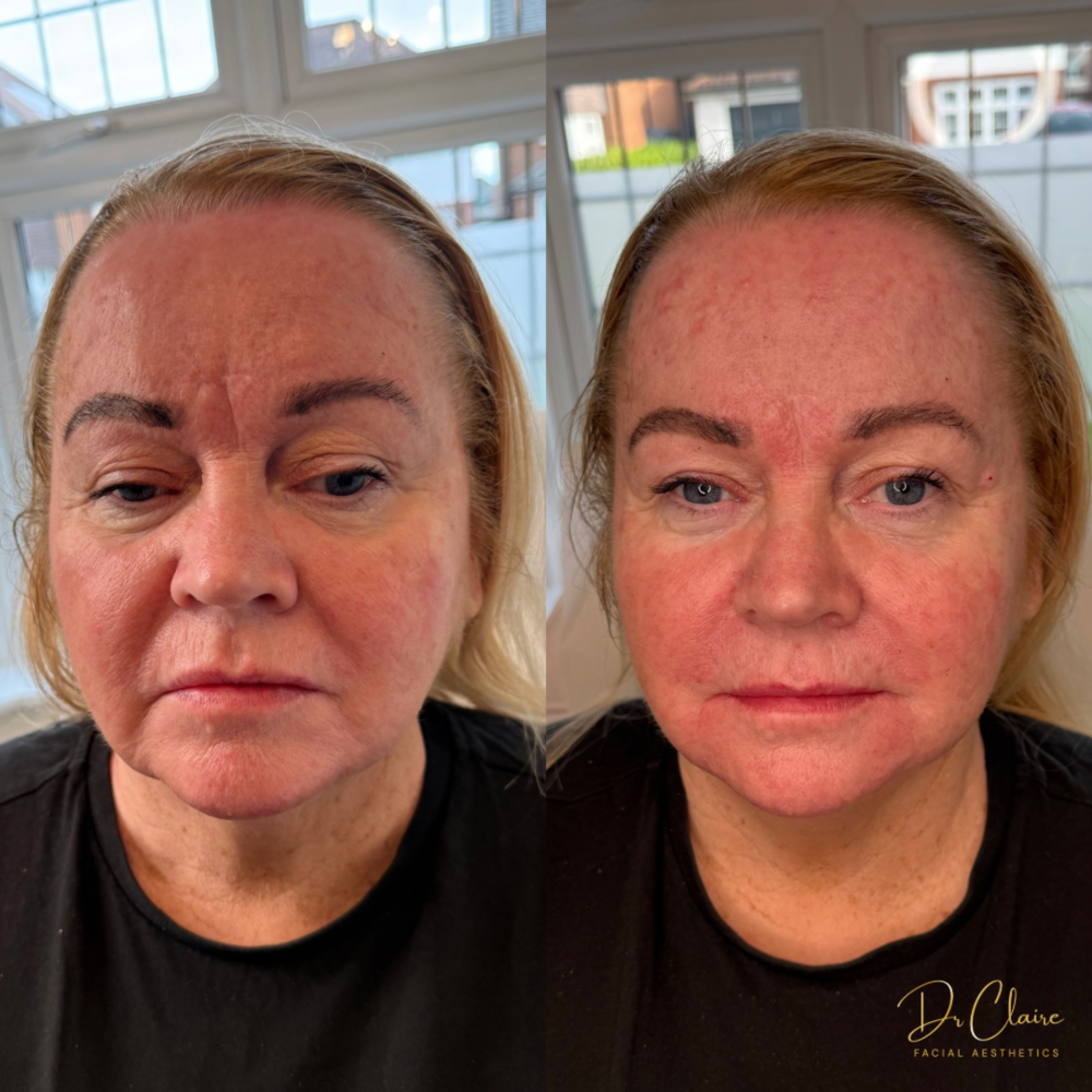 Transformations | Dr Claire Facial Aesthetics | Botox Chorley | Fillers Chorley | Aesthetics Chorley | Botox Treatments Chorley | Dermal Fillers Chorley | Aesthetic Enhancements Chorley