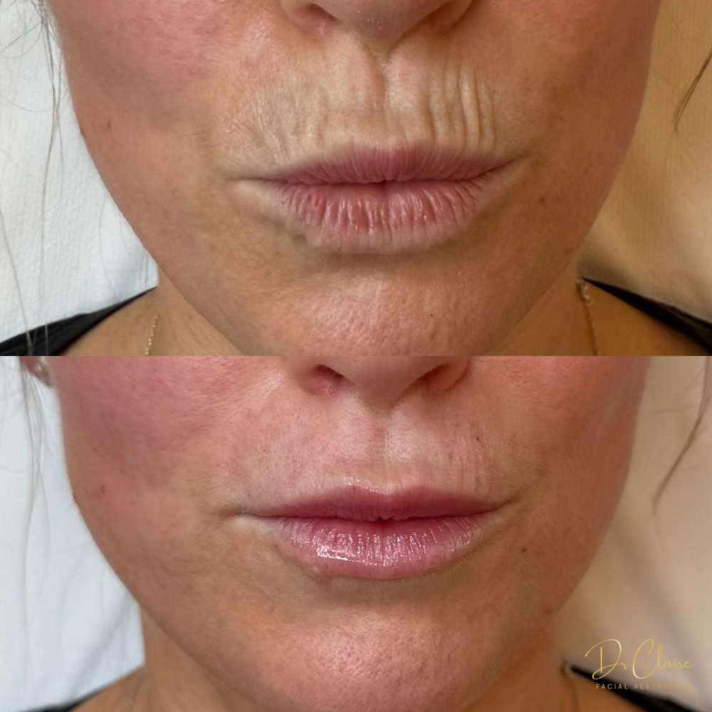 Transformations | Dr Claire Facial Aesthetics | Botox Chorley | Fillers Chorley | Aesthetics Chorley | Botox Treatments Chorley | Dermal Fillers Chorley | Aesthetic Enhancements Chorley