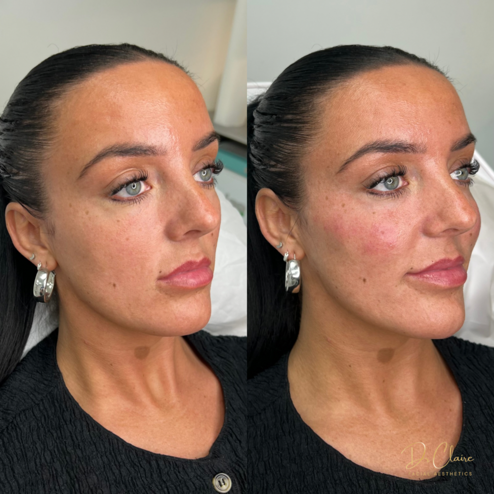 Transformations | Dr Claire Facial Aesthetics | Botox Chorley | Fillers Chorley | Aesthetics Chorley | Botox Treatments Chorley | Dermal Fillers Chorley | Aesthetic Enhancements Chorley